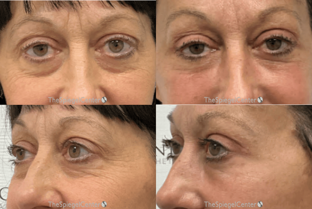Facial Fat Grafting Before & After Gallery - Patient 258111 - Image 1