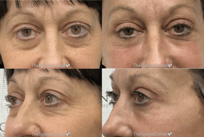 Facial Fat Grafting Before & After Gallery - Patient 258111 - Image 1