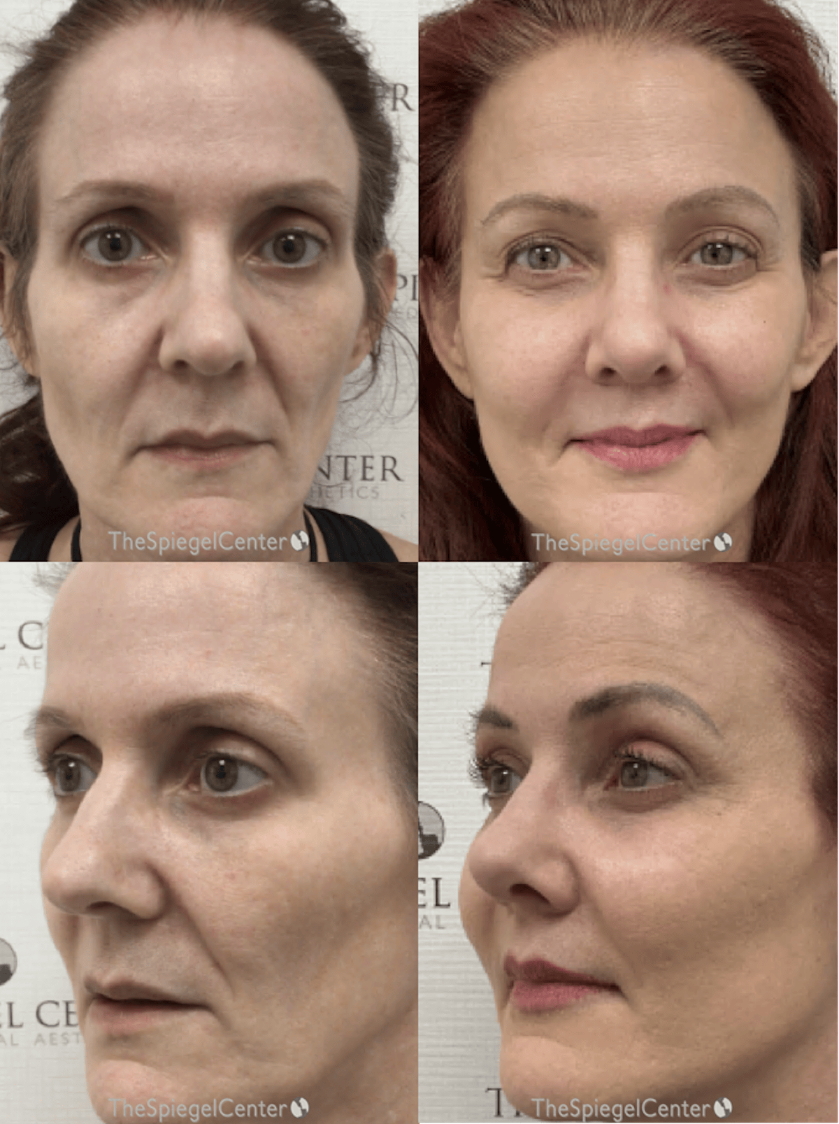 Facial Fat Grafting Before & After Gallery - Patient 304546 - Image 1