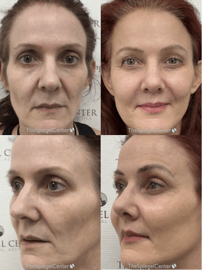 Facial Fat Grafting Before & After Gallery - Patient 304546 - Image 1
