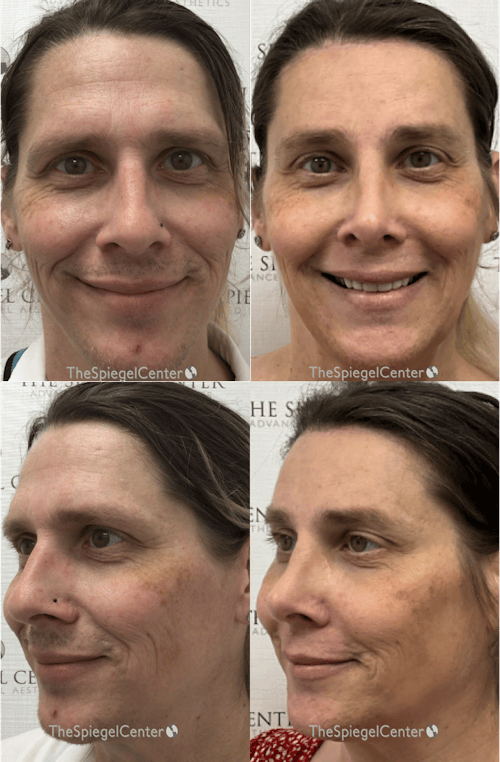 Facial Fat Grafting Before & After Gallery - Patient 327275 - Image 1