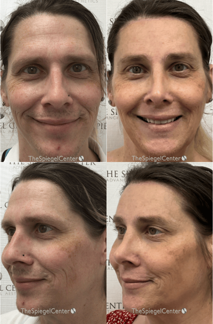 Facial Fat Grafting Before & After Gallery - Patient 327275 - Image 1