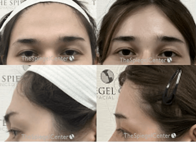 Forehead Contouring Before & After Gallery - Patient 102420 - Image 1