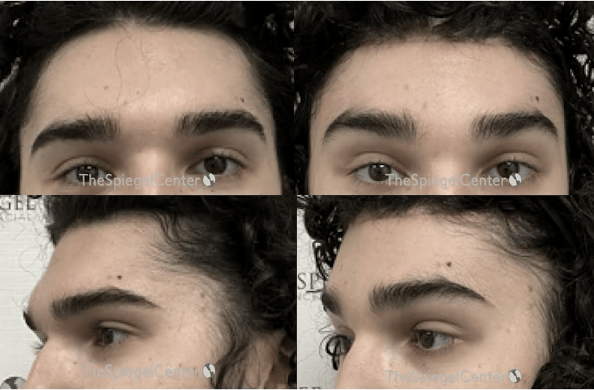 FFS Forehead Contouring Before & After Gallery - Patient 201374 - Image 1