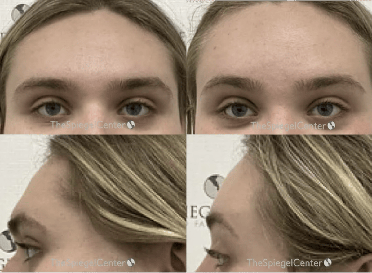 Forehead Contouring Before & After Gallery - Patient 135994 - Image 1