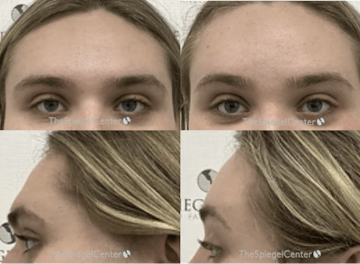 Forehead Contouring Before & After Gallery - Patient 135994 - Image 1