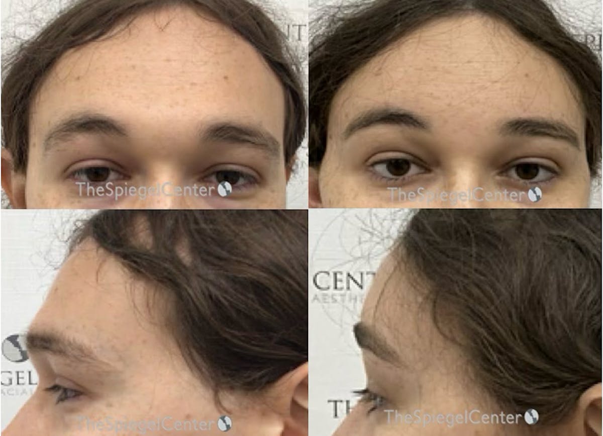 FFS Forehead Contouring Before & After Gallery - Patient 340634 - Image 1