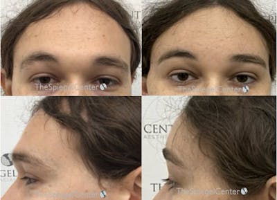 Forehead Contouring Before & After Gallery - Patient 668059 - Image 1