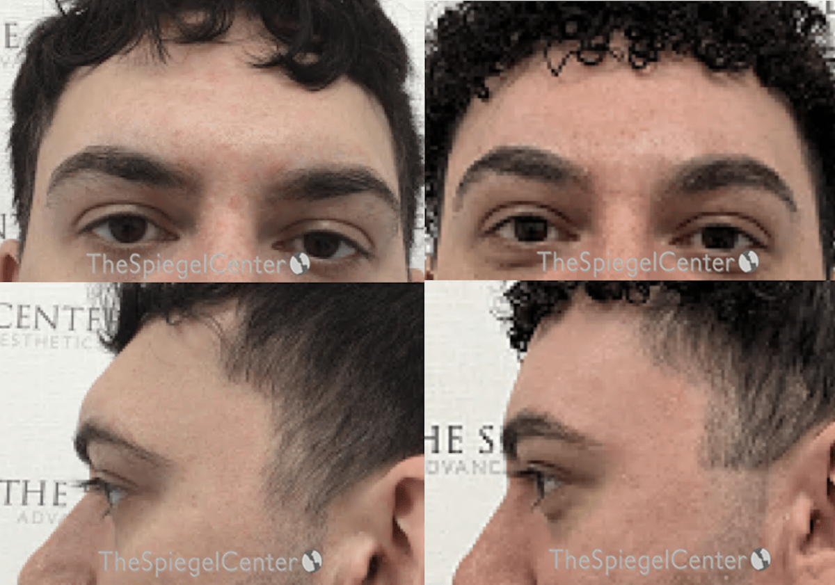 Forehead Contouring Before & After Gallery - Patient 338054 - Image 1