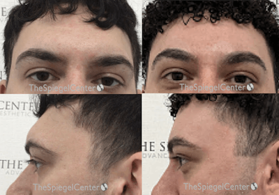 Forehead Contouring Before & After Gallery - Patient 338054 - Image 1