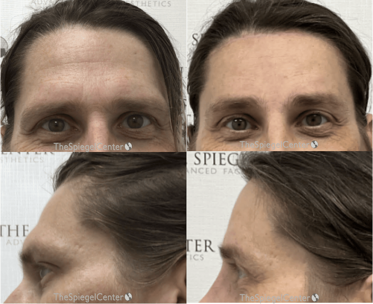 Forehead Contouring Before & After Gallery - Patient 140214 - Image 1