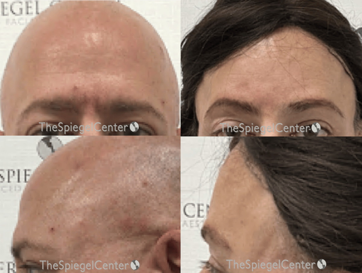 Forehead Contouring Before & After Gallery - Patient 137546 - Image 1