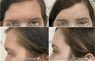 Forehead Contouring Before & After Gallery - Patient 372691 - Image 1