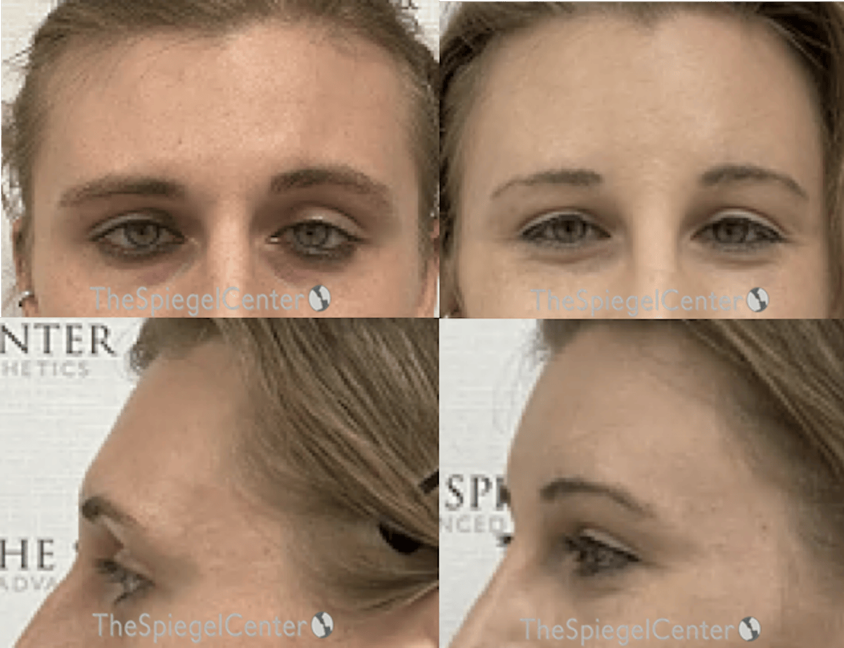 FFS Forehead Contouring Before & After Gallery - Patient 334969 - Image 1