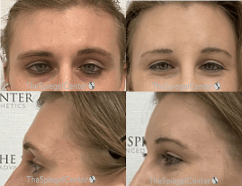 Forehead Contouring Before & After Gallery - Patient 343139 - Image 1