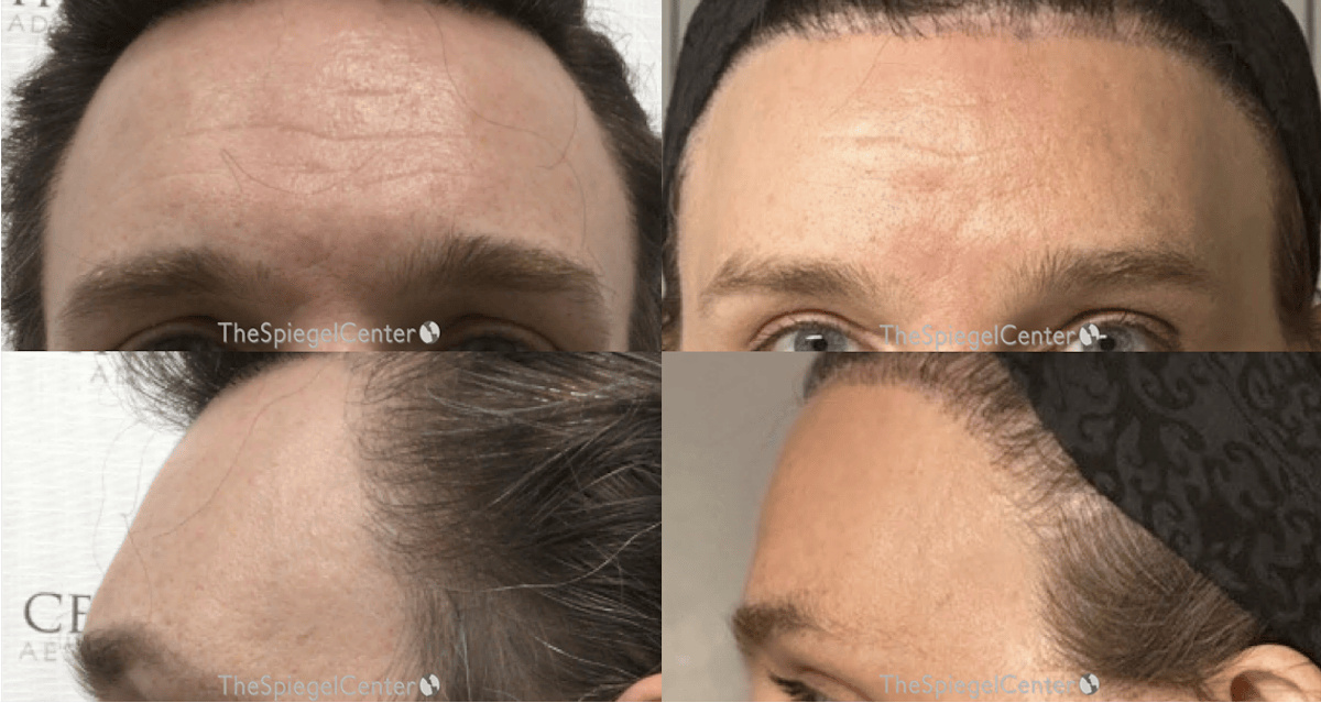FFS Forehead Contouring Before & After Gallery - Patient 241560 - Image 1
