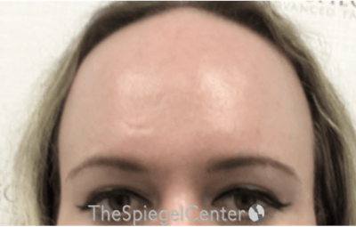 Forehead Contouring Before & After Gallery - Patient 120536 - Image 1