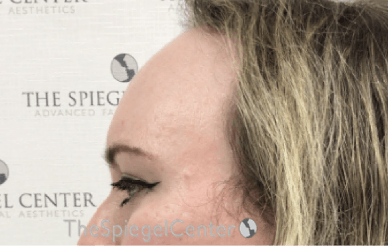 Forehead Contouring Before & After Gallery - Patient 120536 - Image 3