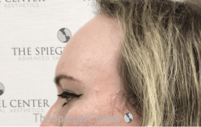Forehead Contouring Before & After Gallery - Patient 120536 - Image 3