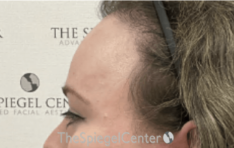 Forehead Contouring Before & After Gallery - Patient 120536 - Image 4