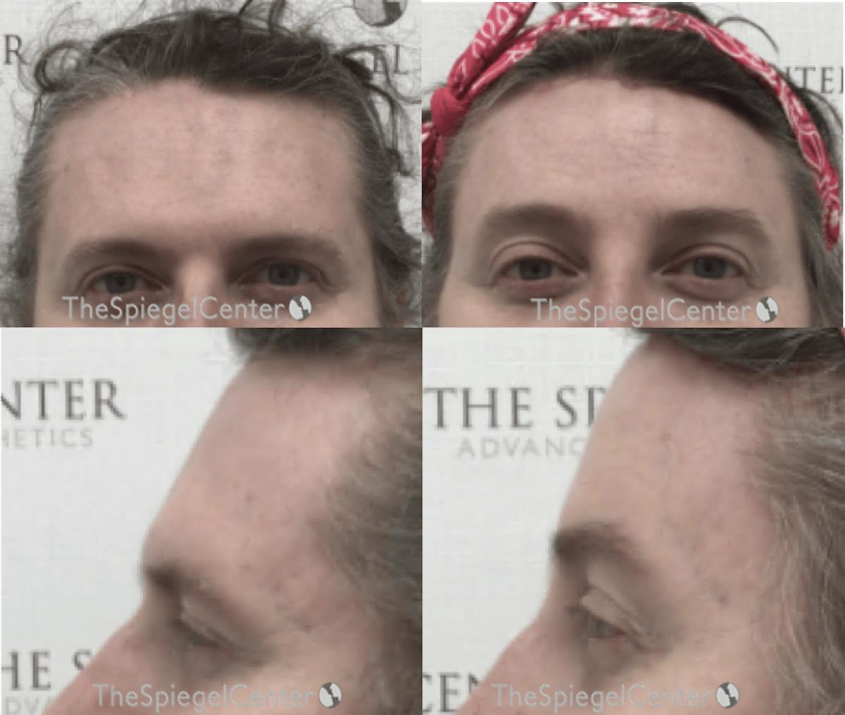 FFS Scalp Advancement Before & After Gallery - Patient 358564 - Image 1
