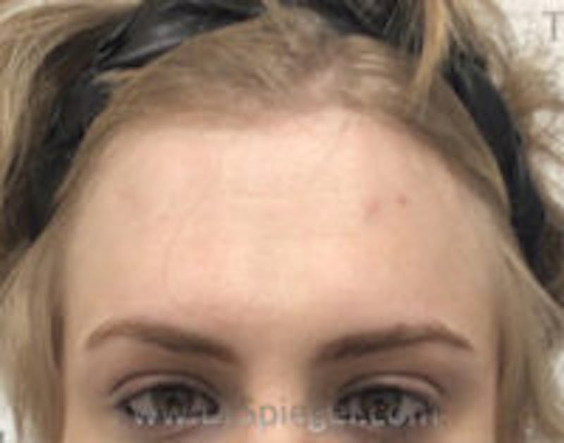 FFS Forehead Contouring Before & After Gallery - Patient 160380 - Image 1