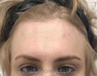 Forehead Contouring Before & After Gallery - Patient 110791 - Image 1
