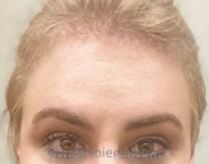 FFS Forehead Contouring Before & After Gallery - Patient 160380 - Image 2