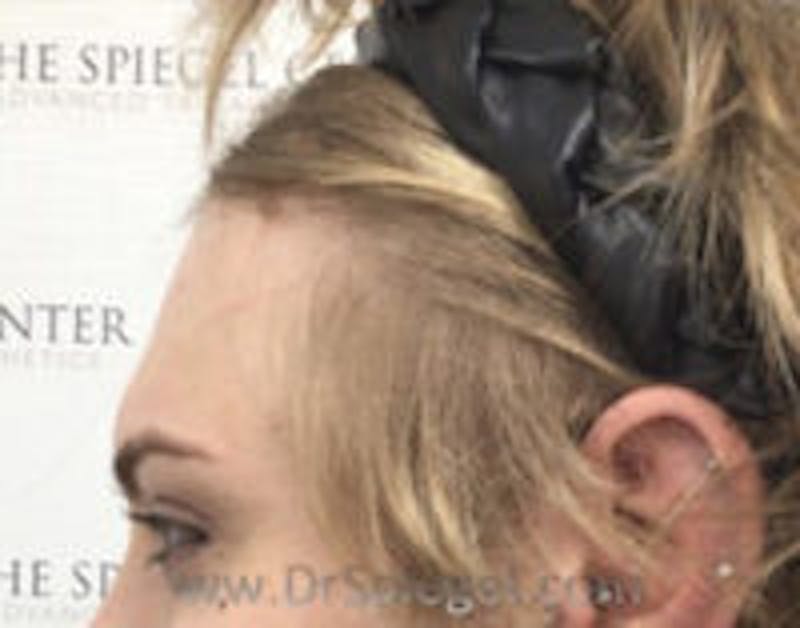 FFS Forehead Contouring Before & After Gallery - Patient 160380 - Image 3
