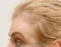 Forehead Contouring Before & After Gallery - Patient 110791 - Image 4