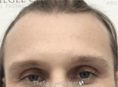 Forehead Contouring Before & After Gallery - Patient 285777 - Image 1
