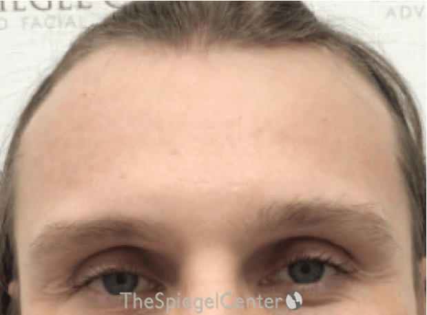 Scalp Advancement Before & After Gallery - Patient 217125 - Image 1