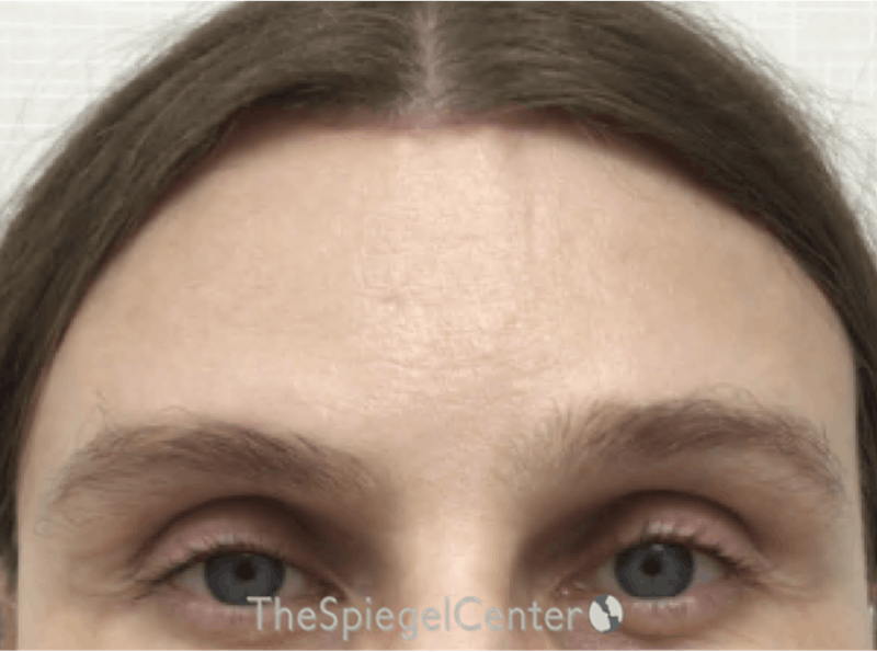 Forehead Contouring Before & After Gallery - Patient 285777 - Image 2