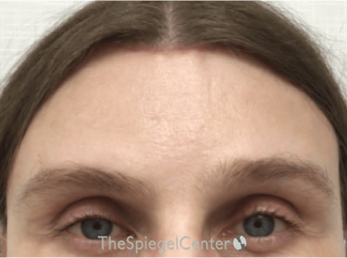 Scalp Advancement Before & After Gallery - Patient 217125 - Image 2