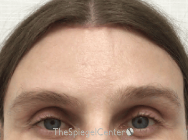 Scalp Advancement Before & After Gallery - Patient 217125 - Image 2