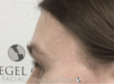 Forehead Contouring Before & After Gallery - Patient 285777 - Image 4