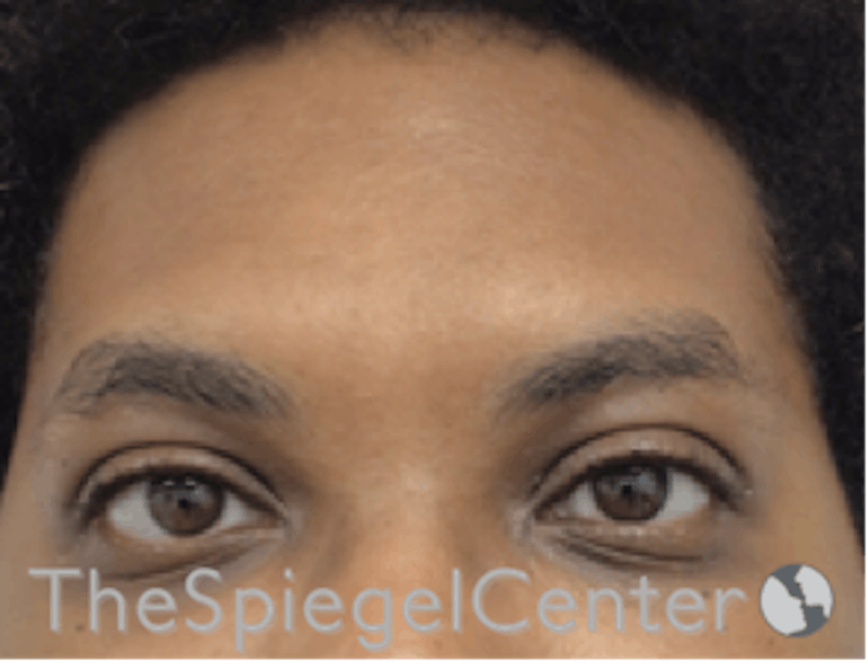 FFS Forehead Contouring Before & After Gallery - Patient 364972 - Image 1