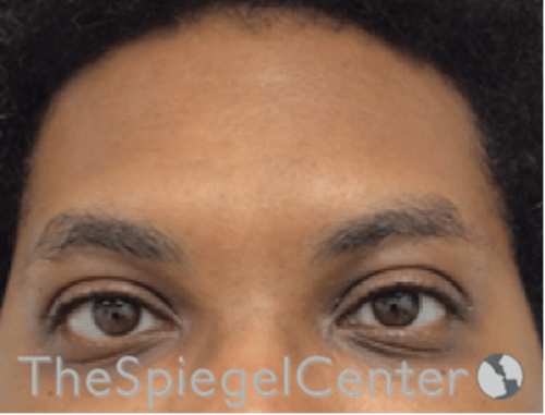 Forehead Contouring Before & After Gallery - Patient 117262 - Image 1