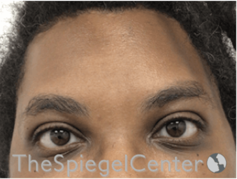 FFS Forehead Contouring Before & After Gallery - Patient 364972 - Image 2