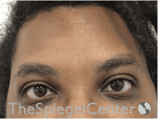 Forehead Contouring Before & After Gallery - Patient 117262 - Image 2