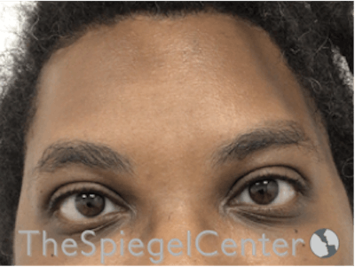Forehead Contouring Before & After Gallery - Patient 117262 - Image 2