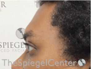 Forehead Contouring Before & After Gallery - Patient 117262 - Image 3