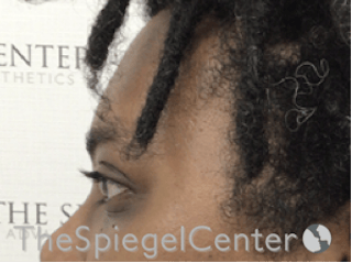 Forehead Contouring Before & After Gallery - Patient 117262 - Image 4