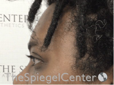 Forehead Contouring Before & After Gallery - Patient 117262 - Image 4