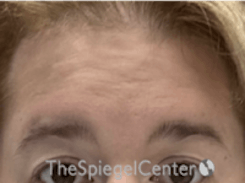 FFS Forehead Contouring Before & After Gallery - Patient 357277 - Image 1