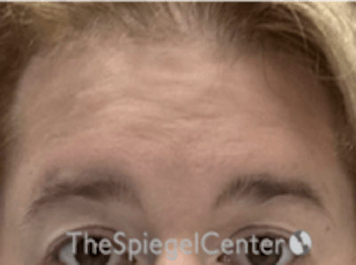 Forehead Contouring Before & After Gallery - Patient 267533 - Image 1