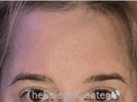 FFS Forehead Contouring Before & After Gallery - Patient 357277 - Image 2