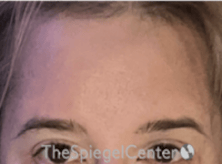 Forehead Contouring Before & After Gallery - Patient 267533 - Image 2
