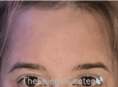 Forehead Contouring Before & After Gallery - Patient 267533 - Image 2
