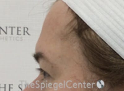 Forehead Contouring Before & After Gallery - Patient 267533 - Image 3